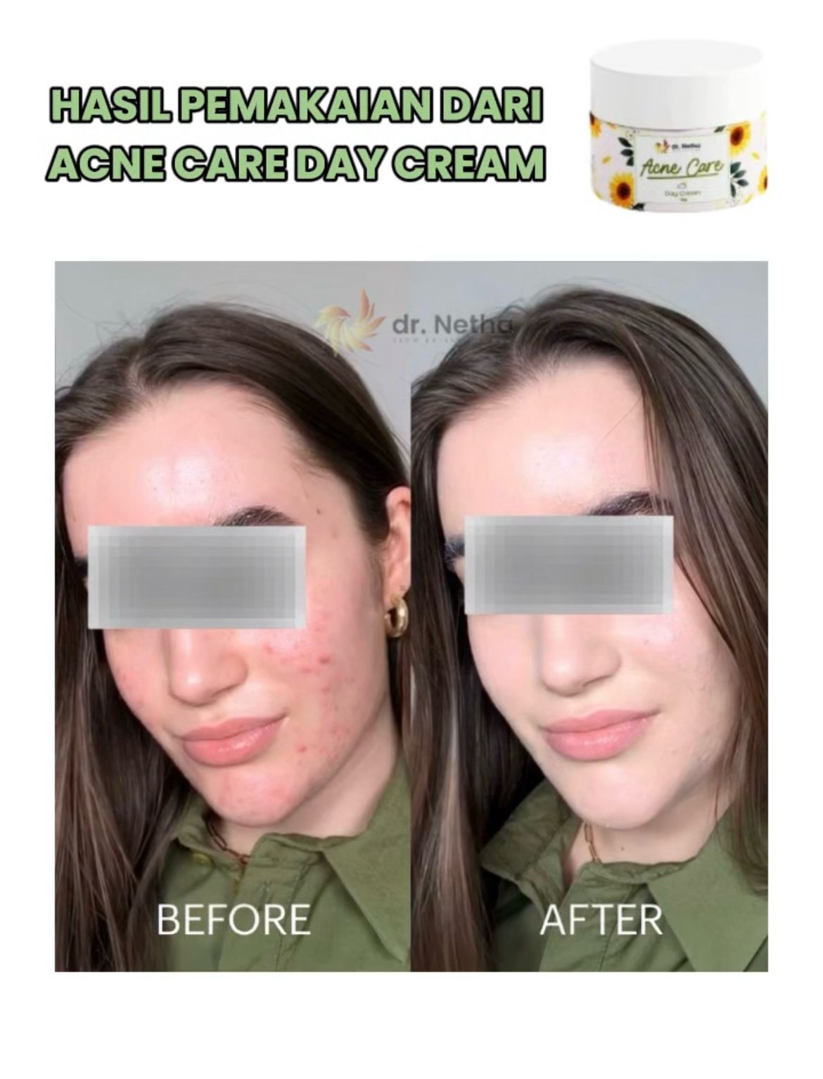 Acne Care Day Cream New Look